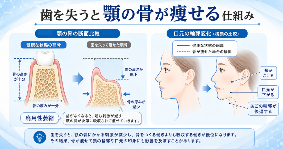 なぜ抜歯後に顎の骨が痩せるのか?「廃用性萎縮」のメカニズムと顔立ちへの影響