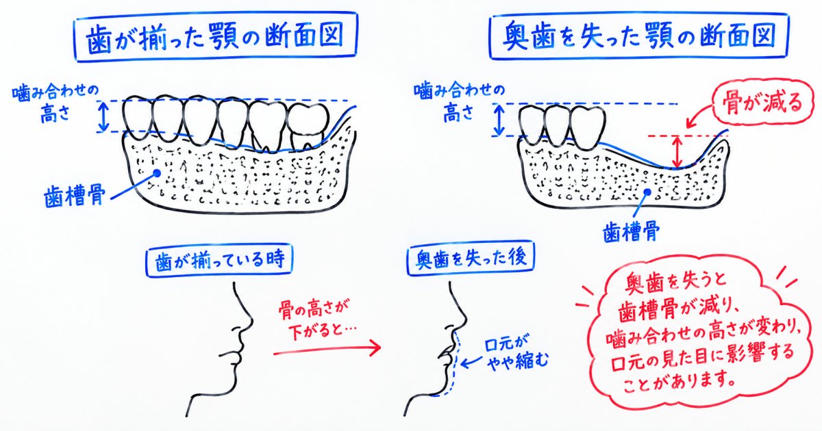 歯を失うと顔が変わるのはなぜか、骨と噛み合わせの関係